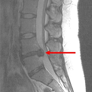 腰椎椎間板ヘルニアMRI画像